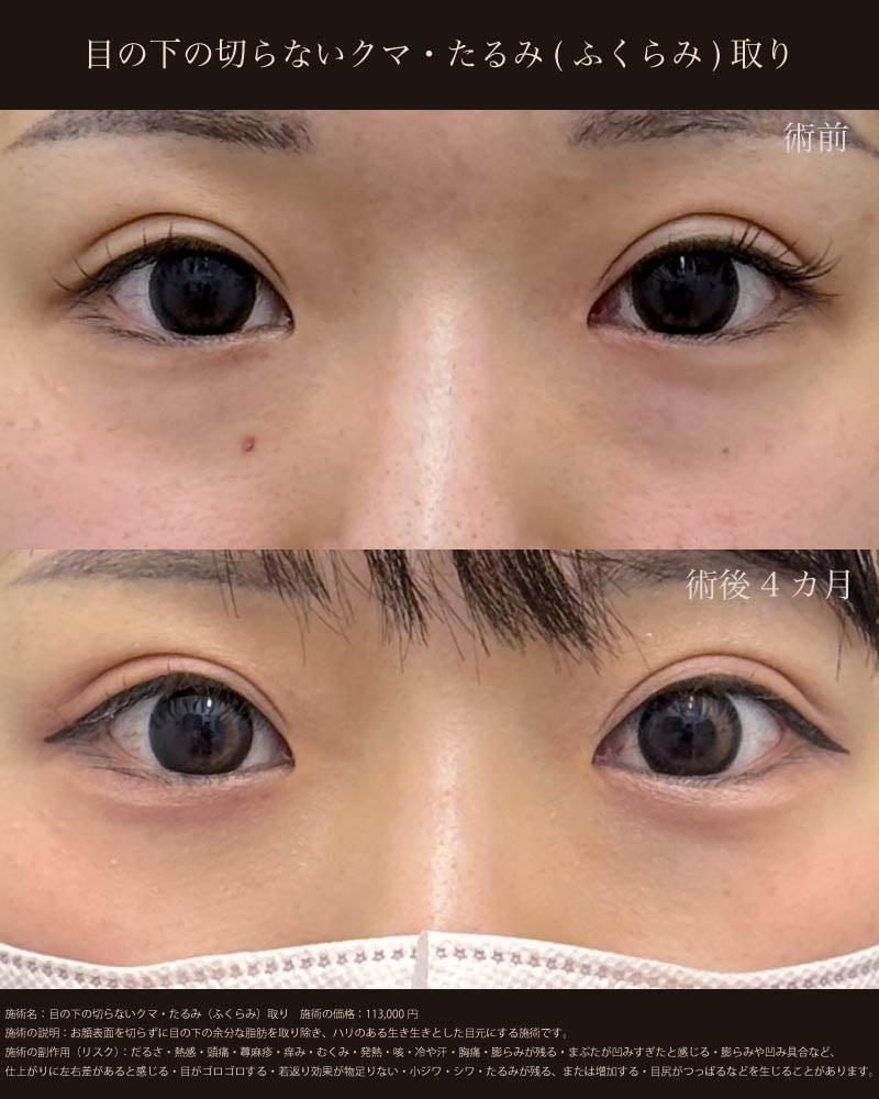 目の下の切らないクマ・たるみ取り（脂肪を取る治療）