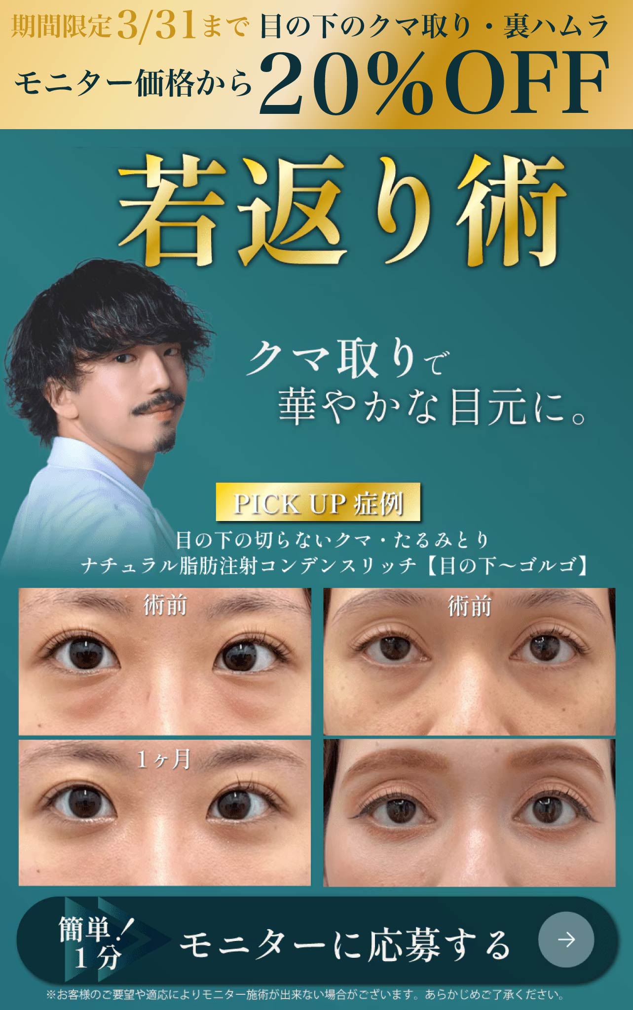 【今ならモニター価格から20％OFF】クマ治療なら圭之輔！