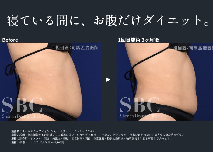 その脂肪、夏までに間に合う。「どこを、何エリア」が美しさの分かれ道。