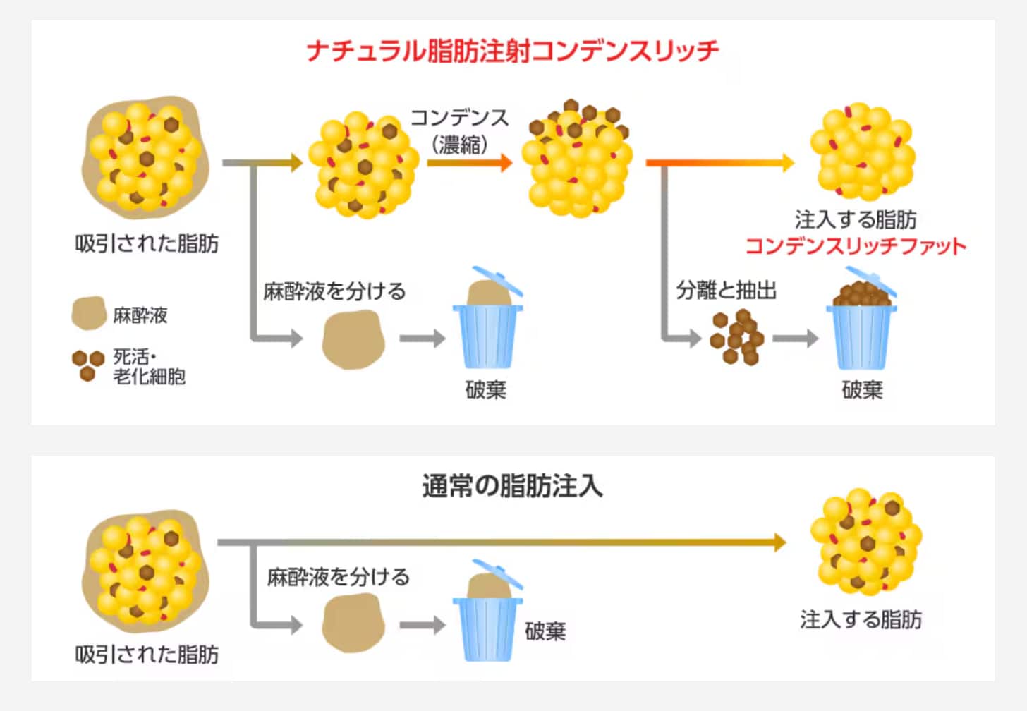 脂肪注入によるクマ治療（凹み・影クマ）