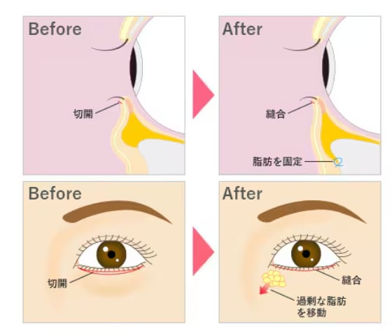 湘南美容クリニックにおいて「切開ハムラ」まで対応できる医師は限られています