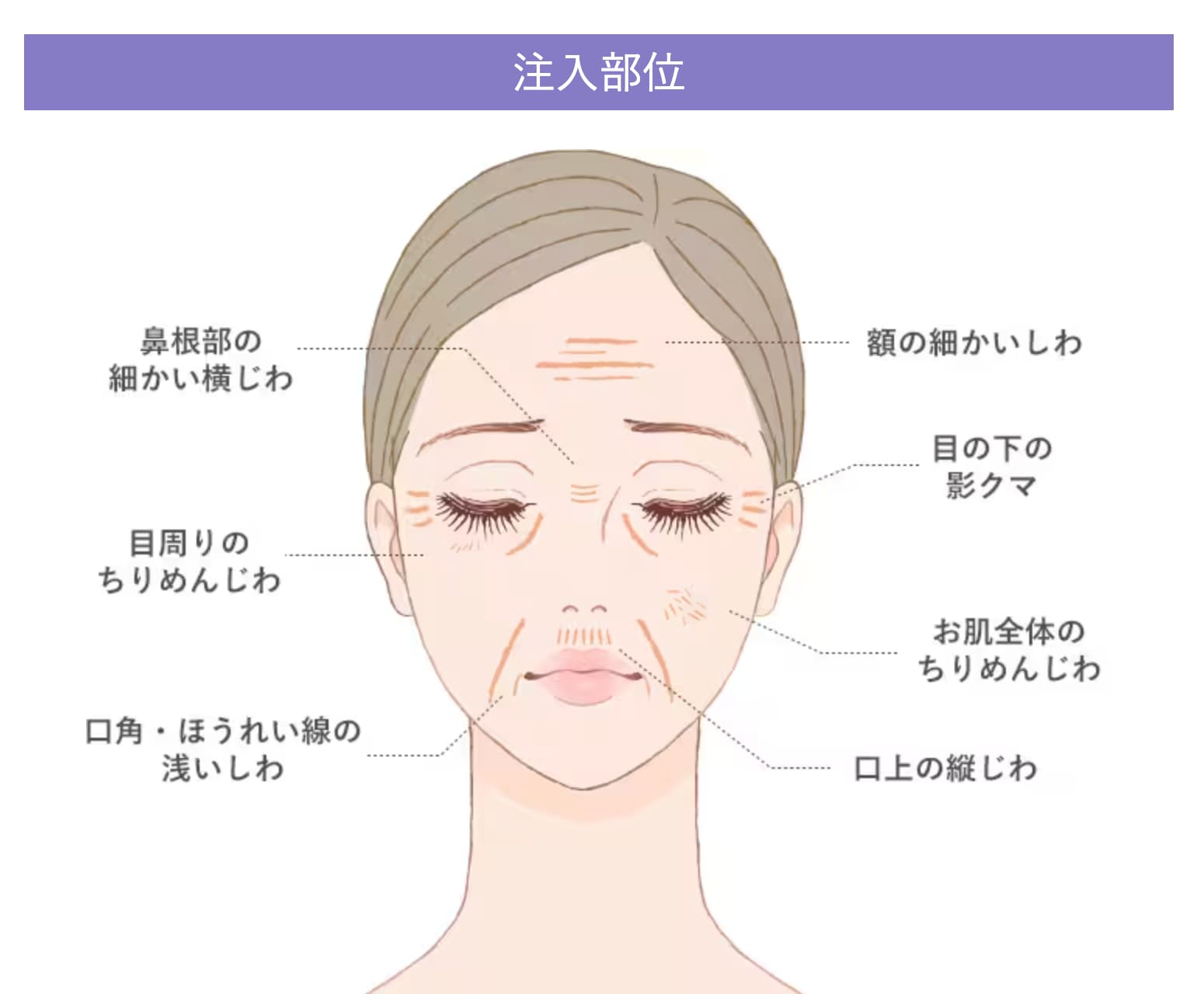 ベビーコラーゲンが注入できる部位は？