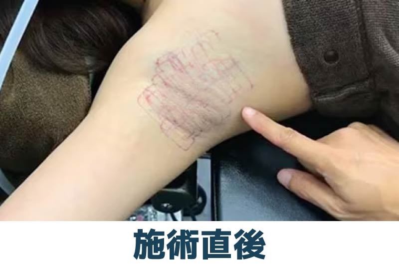 ダウンタイムが短い