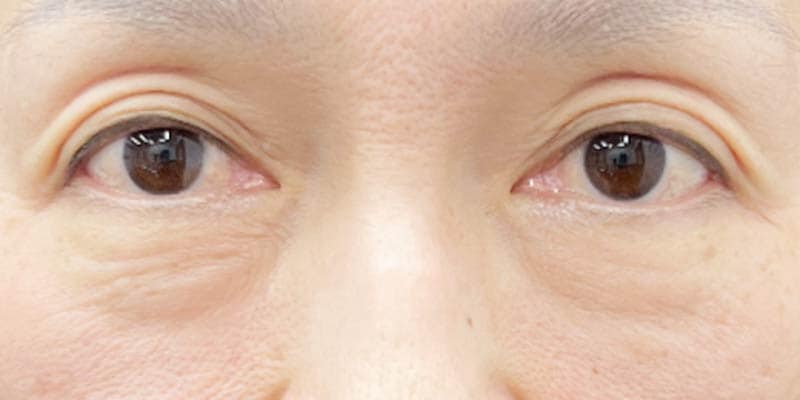 【原因①】目の下のふくらみ