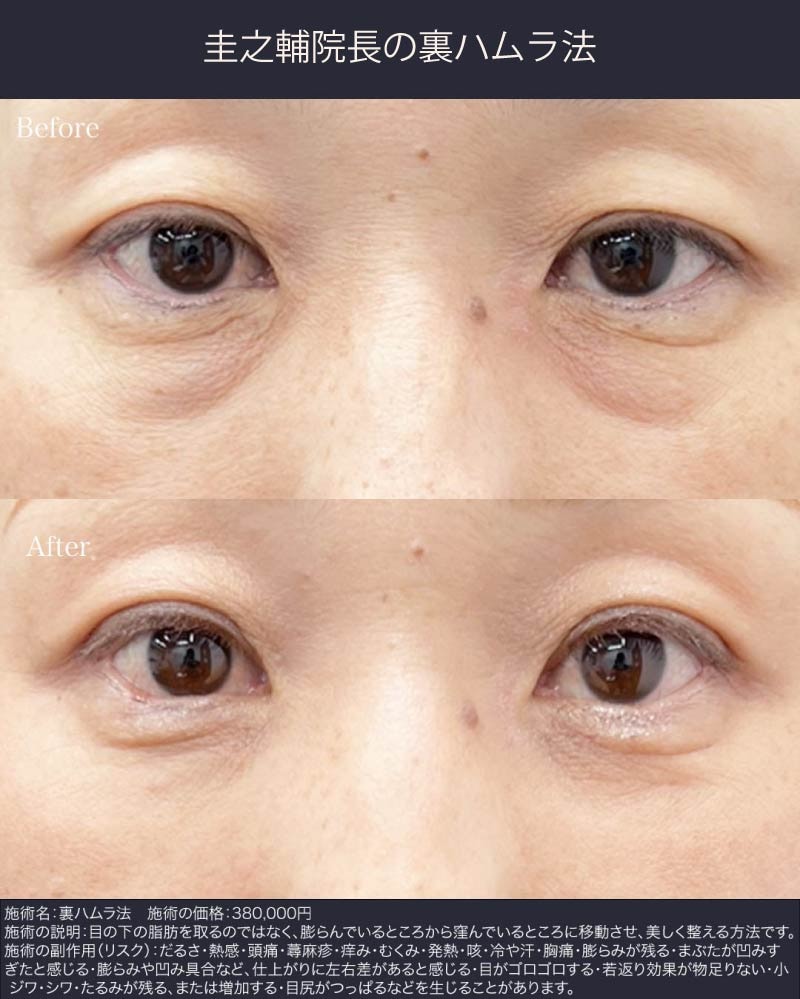 40代症例：裏ハムラ法