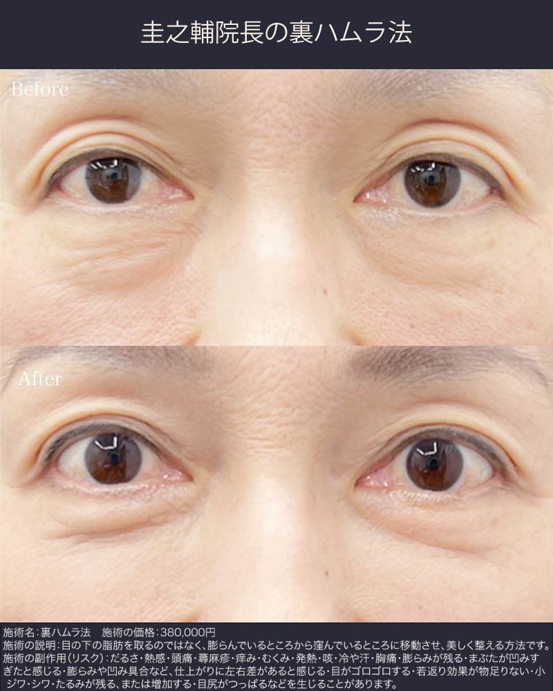 60代症例：裏ハムラ法