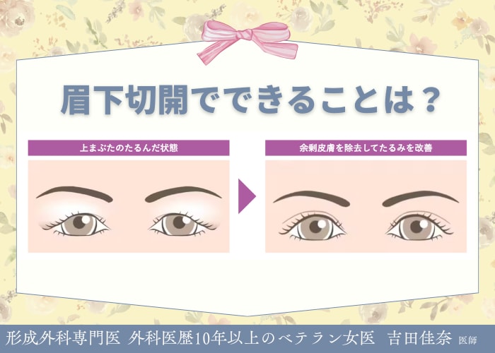 眉下切開は、二重整形するか悩んでいる方にもおすすめ！