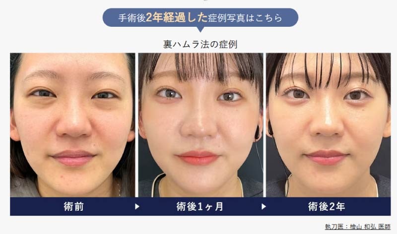 「腫れが引いた＝完成」ではありません