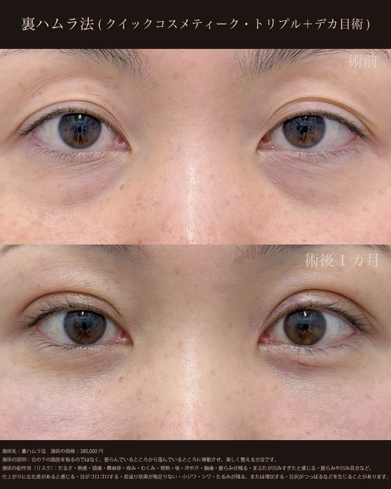 裏ハムラ法（脂肪を移動させる治療）
