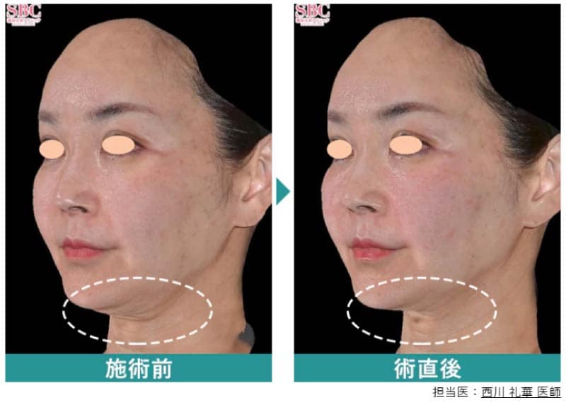 圧倒的なタイトニング（引き締め）効果