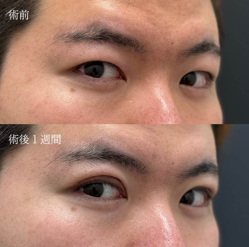 1週間後の感動。抜糸直後でも「完成」を予感させる仕上がり