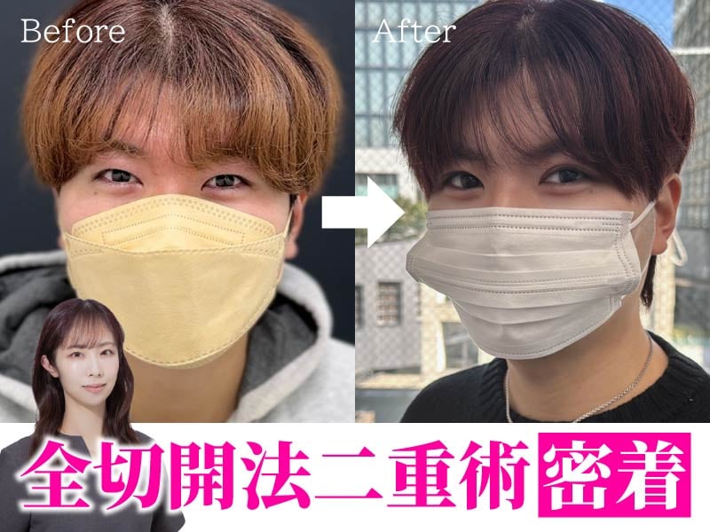 術後1週間で驚きの完成度！湘南美容クリニック川崎院・吉田佳奈医師の「腫れの少ない全切開二重術」に密着