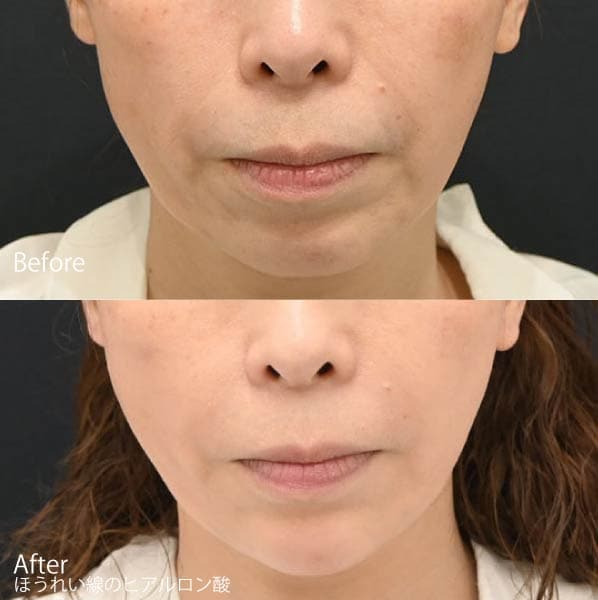 ほうれい線・ゴルゴライン・マリオネットライン（XC、ボリフト、ボリューマ）