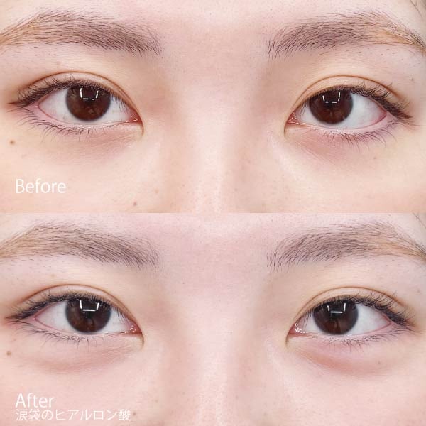 唇・涙袋の繊細なボリュームアップ（RHA1、ボルベラ）