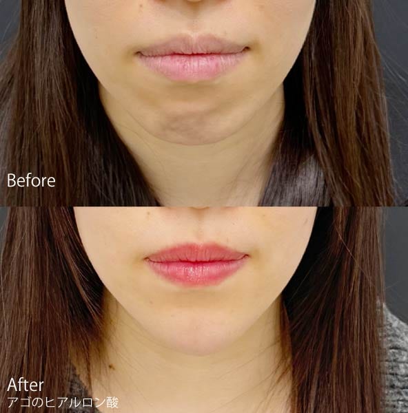 鼻筋・顎をシャープに整える（ピネハウルトラ、ボラックス）