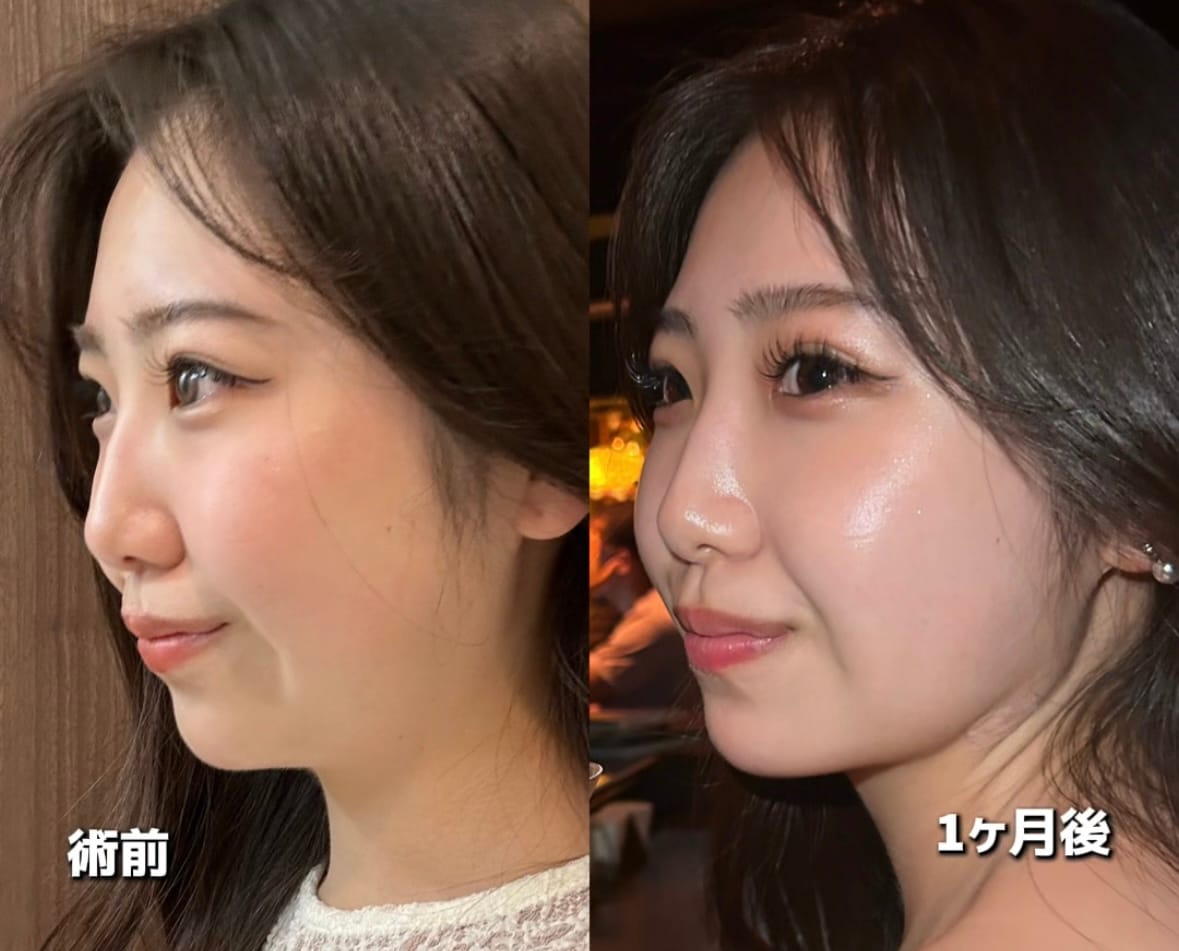 術後1ヶ月：二重顎が消えた！理想のラインを実感