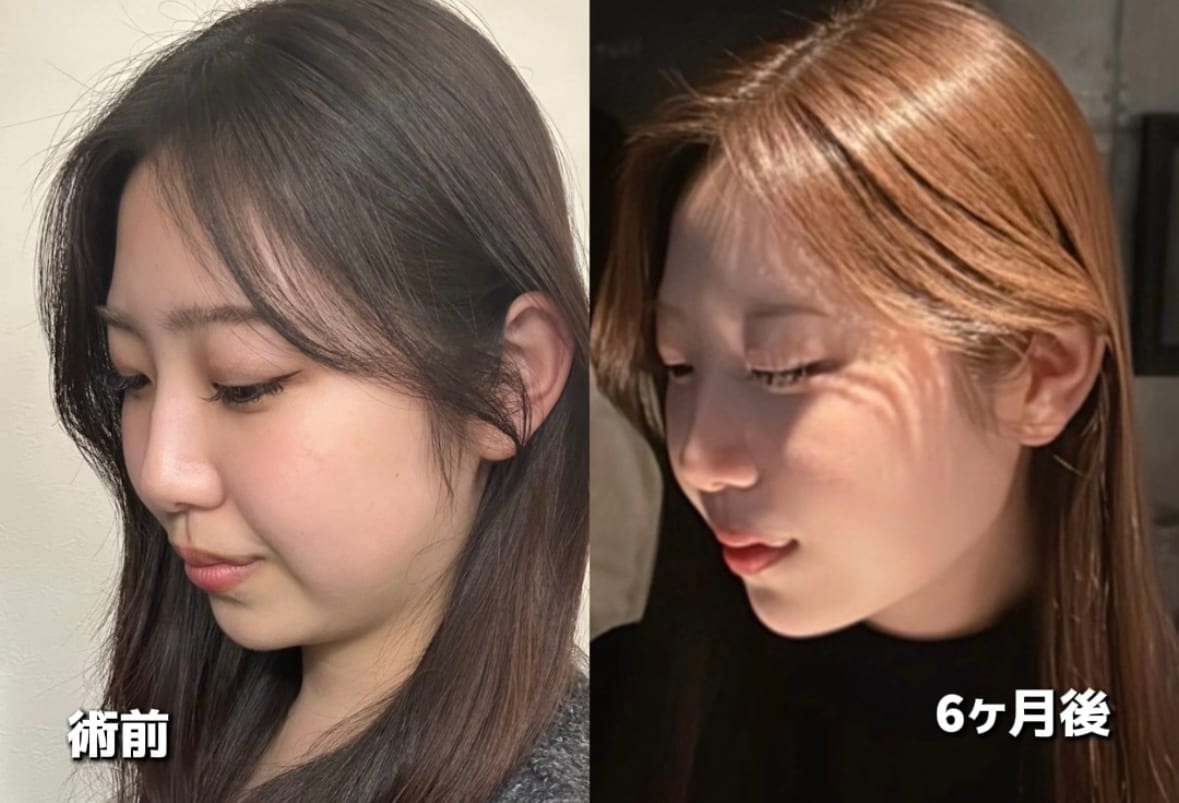 半年後には完成されたフェイスライン！