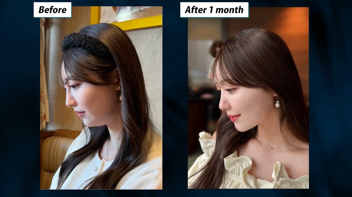 医師が解説する脂肪吸引の定義と術後の経過