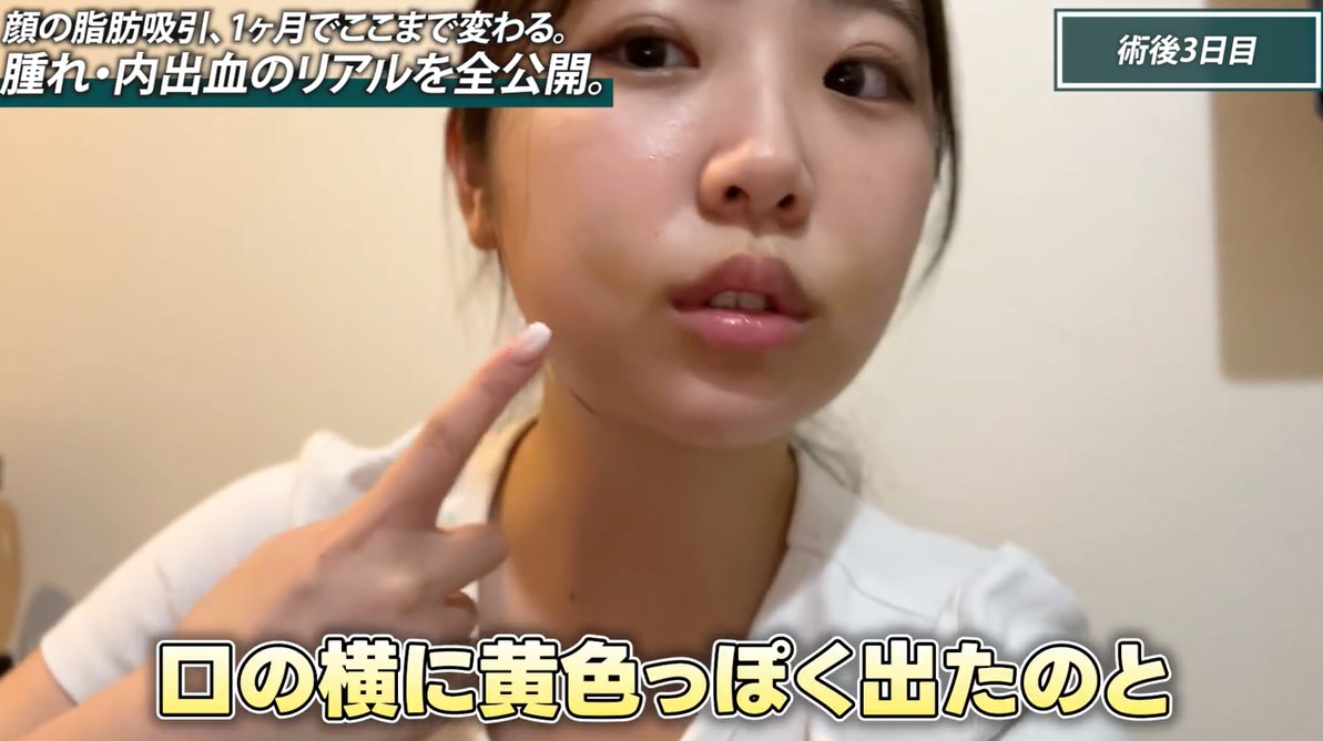 ダウンタイム中に起こる主な症状：腫れ・内出血・拘縮