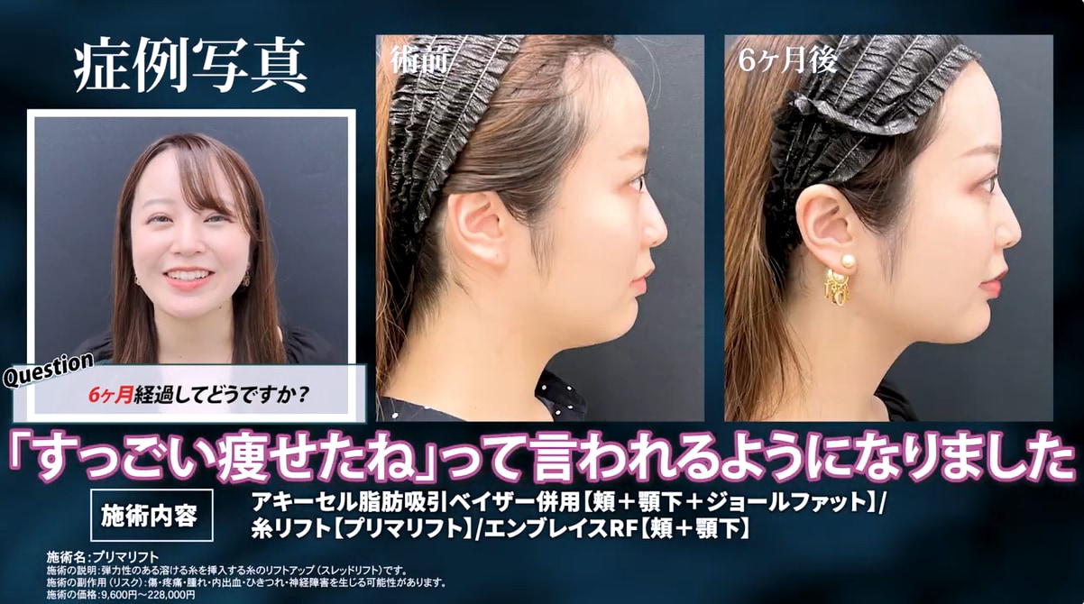 脂肪吸引×エンブレイスRFで小顔へ｜湘南美容クリニック川崎院・佐藤圭之輔院長の関東1位の小顔術