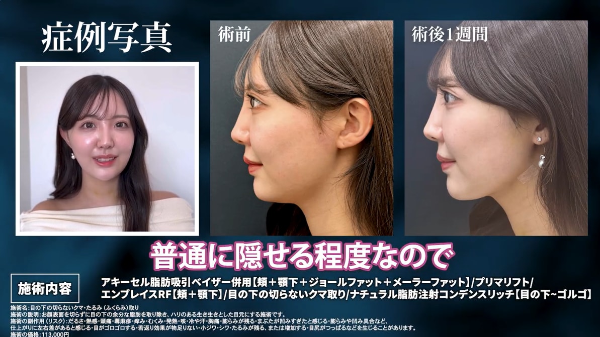 １週間でもうダウンタイム終了？