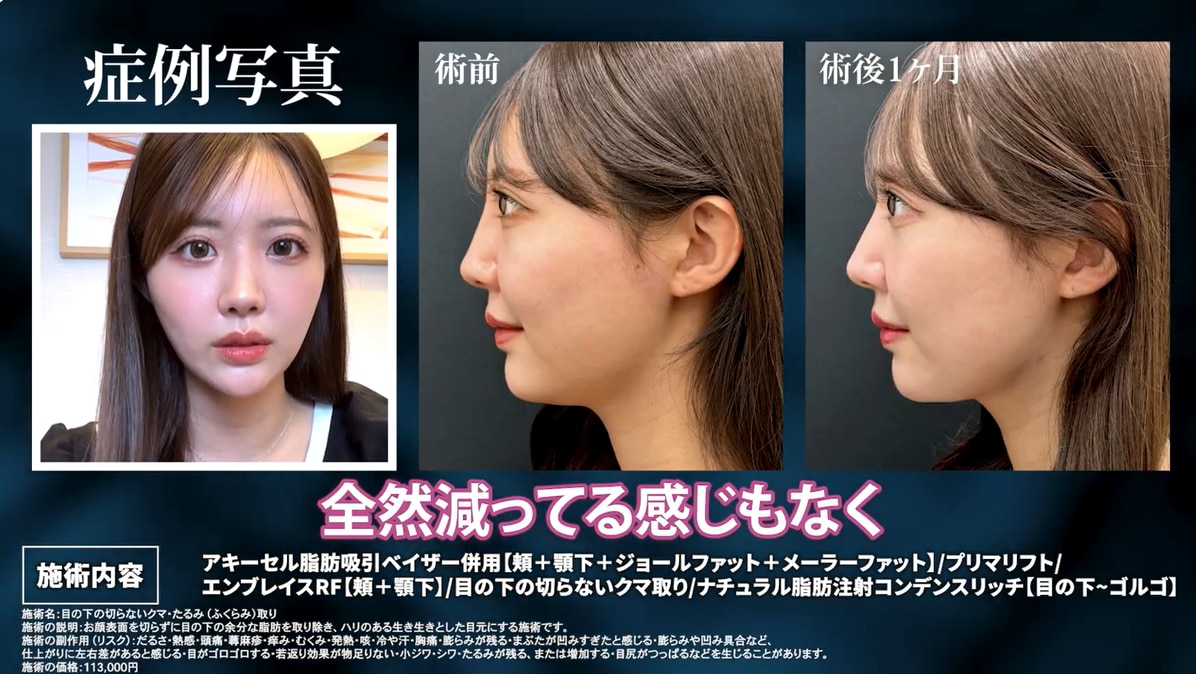 脂肪注入の定着も順調