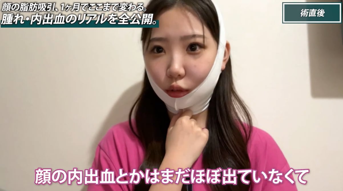 術後当日〜2日目：顔がパンパン！でも翌日から仕事に行ける？