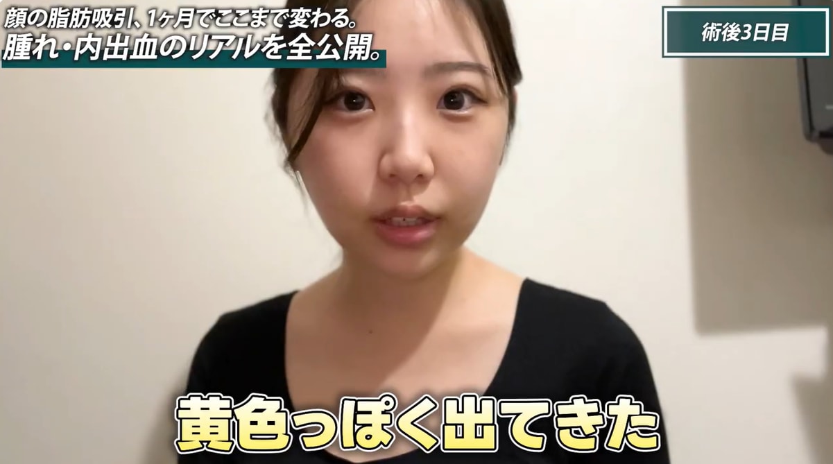 3日目〜4日目：内出血が「下」に降りてくる時期