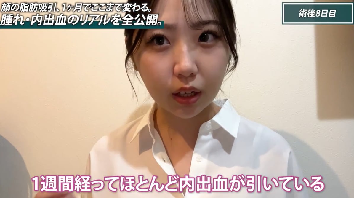 術後1週間：突っ張り感が消えて楽になるタイミング