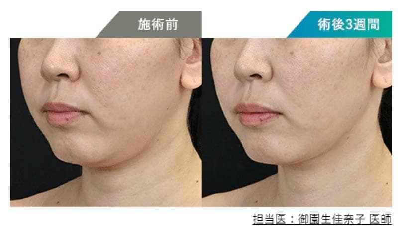 痛み・ダウンタイムは最小限！直後からメイクもオッケー