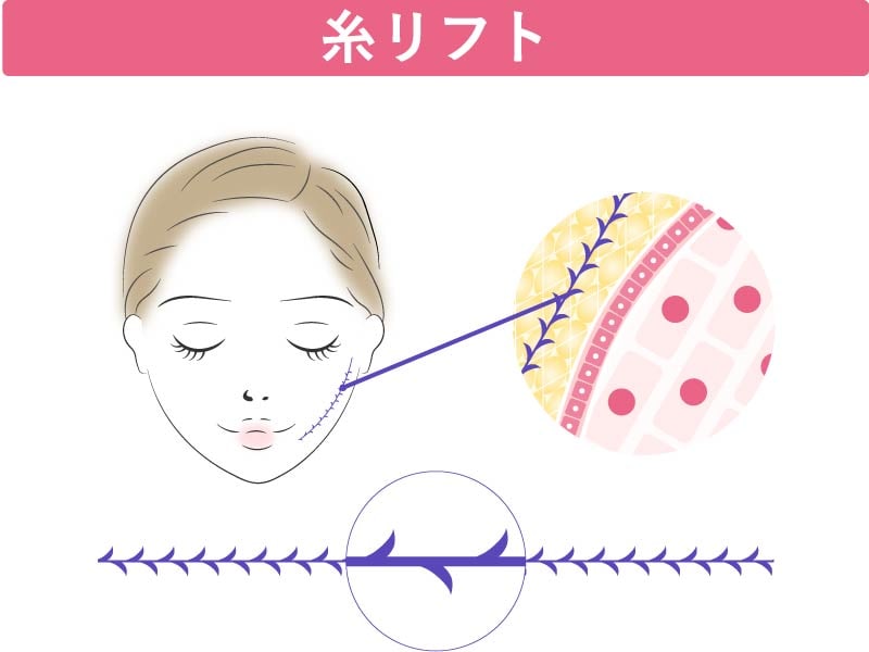 糸リフトとはどのような施術か
