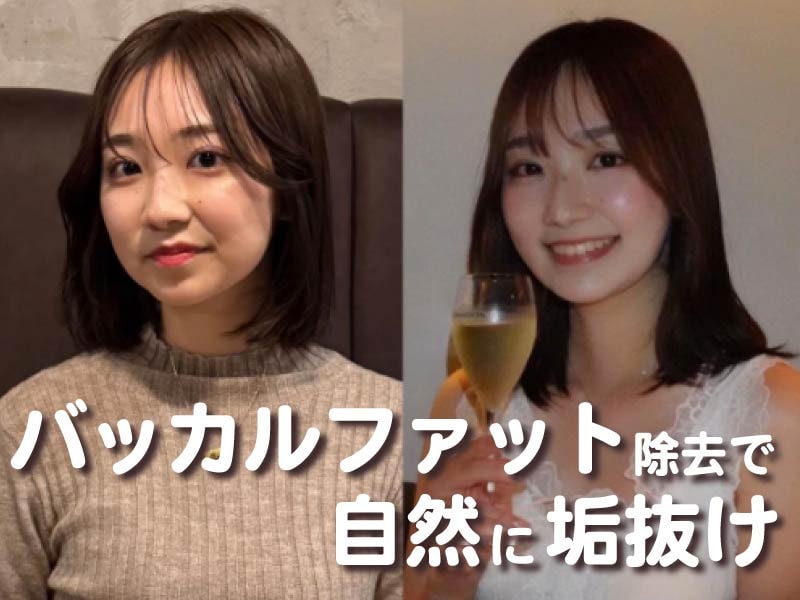 【湘南美容クリニック川崎】バッカルファット除去で下膨れ(リス顔)から卵型の輪郭へ!圭之輔院長の小顔術