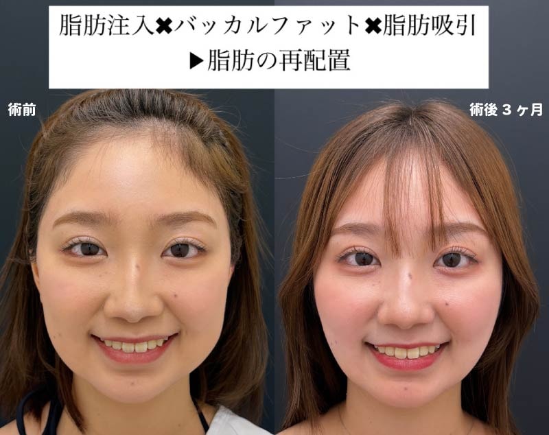 脂肪吸引との併用がオススメ！