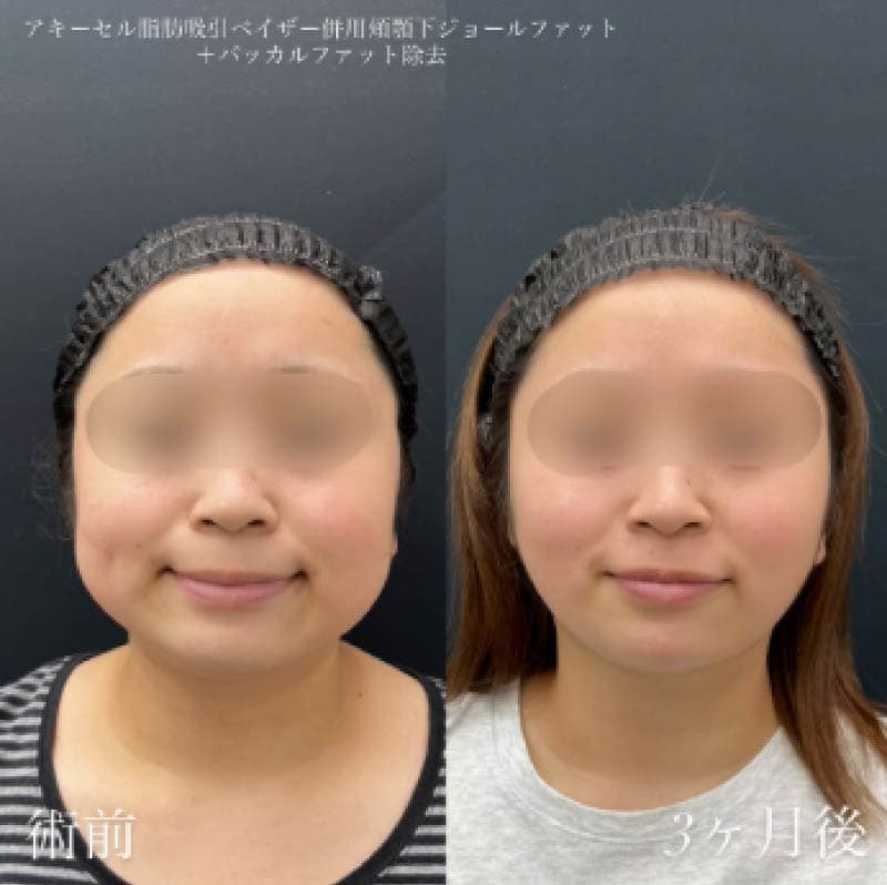 バッカルファット除去の症例①
