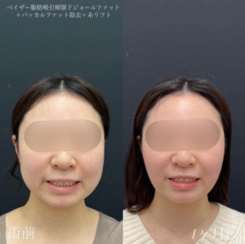 バッカルファット除去の症例②