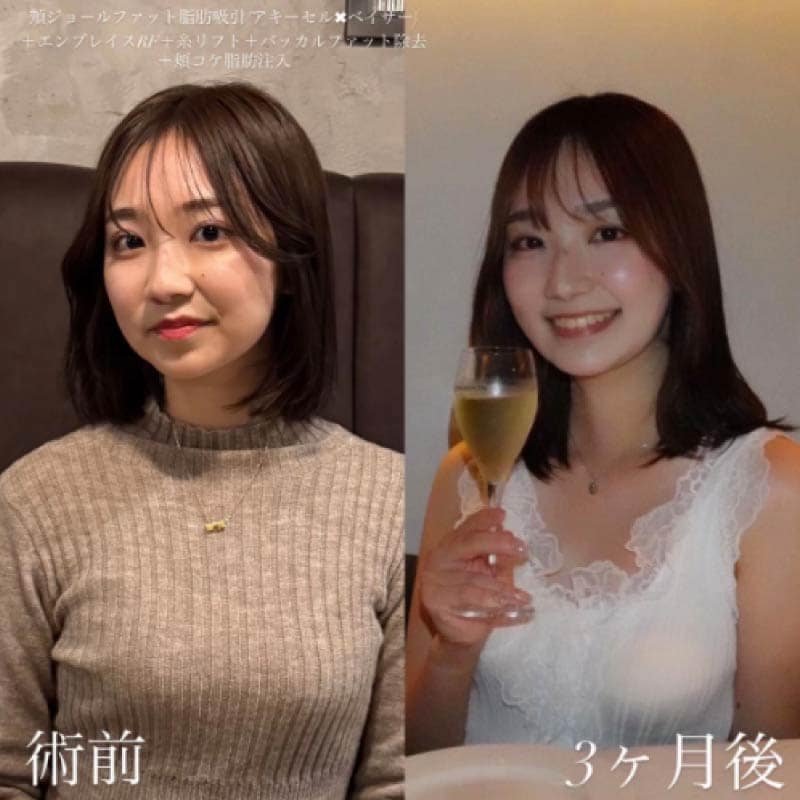 バッカルファット除去のメリット
