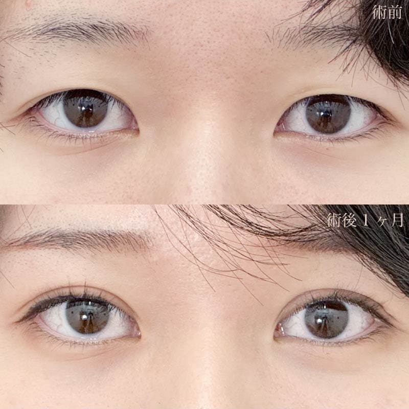【全切開法二重術】半永久的な理想の二重ラインと極小の傷跡