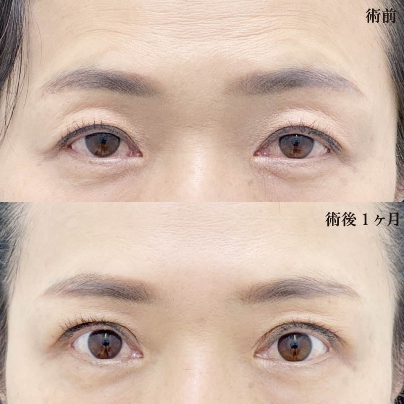 【眼瞼下垂術】「眠そうな目」を改善し、自然でパッチリとした目元へ