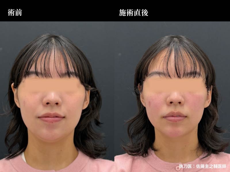 オンダリフト：痛みが苦手な方へ！脂肪細胞を加熱してすっきり小顔へ
