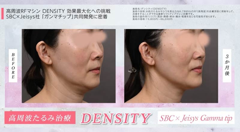 直後からキュッと上がって、3ヶ月後にはさらに引き締め効果が！