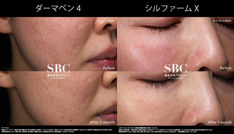 凹凸（クレーター）には「ダーマペン」＆「シルファームX」