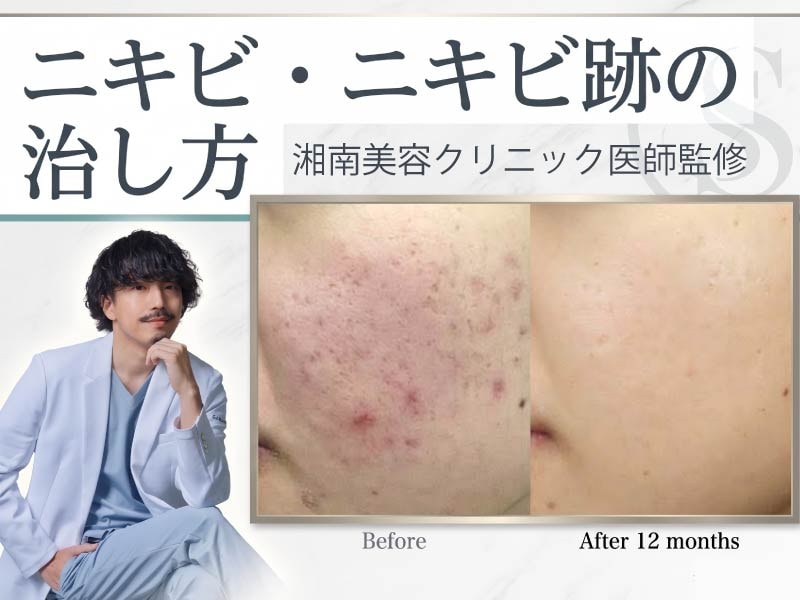【医師監修】川崎でニキビ・ニキビ跡を治す!市販薬や漢方で治らない原因と皮膚科美容医療の治療法