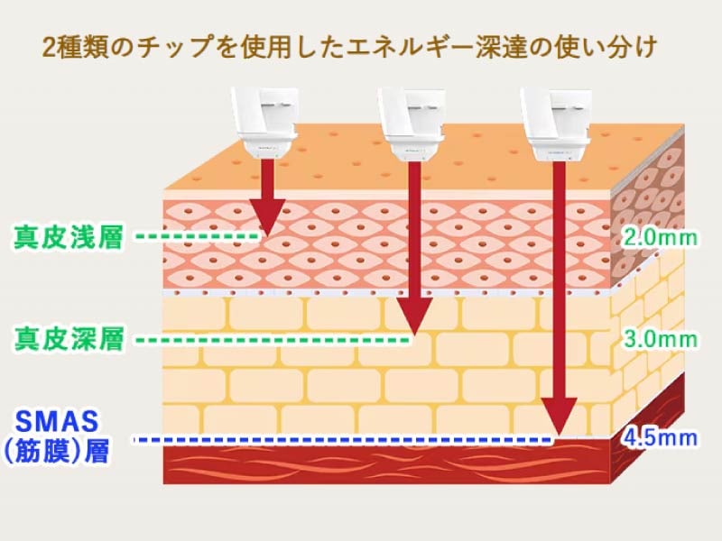 2種類のチップと深さの使い分けによる立体的なアプローチ