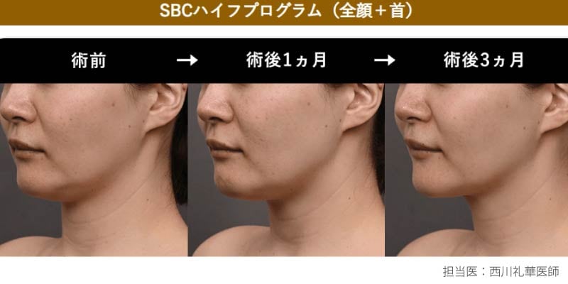 施術直後から効果持続期間までのプロセス