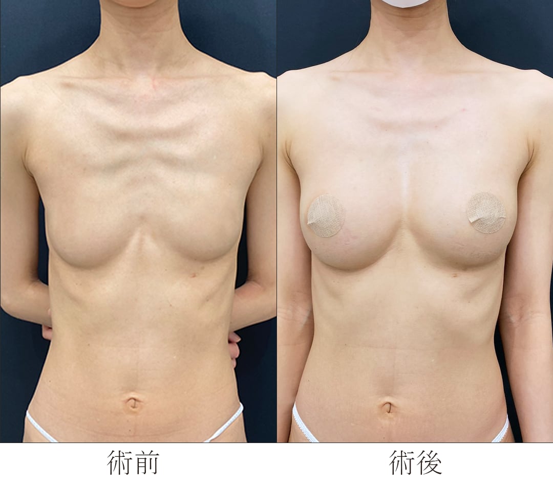 お椀型の大きなおっぱい 都内で豊胸するなら”ラウンドバスト豊胸”でまん丸美乳を生み出す、湘南美容クリニック吉祥寺院のあやこむ先生へおまかせ！ - 吉祥寺院