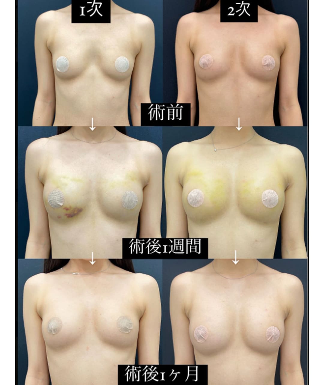 巨乳化 脂肪豊胸で爆乳になりたい方におすすめ！【二次豊胸】とは - 吉祥寺院