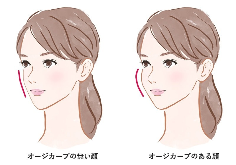 自然なオージーカーブ形成と脂肪注入による若々しい印象