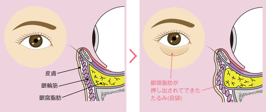 目の下のクマ(たるみ)の原因は?