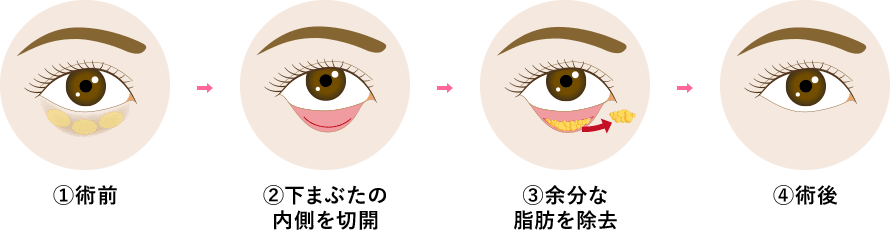 目の下の切らないクマ・たるみ取りとはどのような施術ですか?