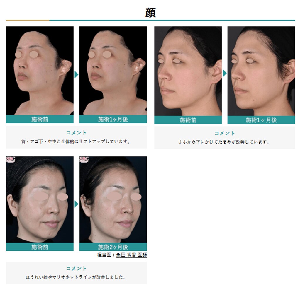 サーマクールに並ぶくらい強力なのに安価に受けられる最新たるみ改善機械